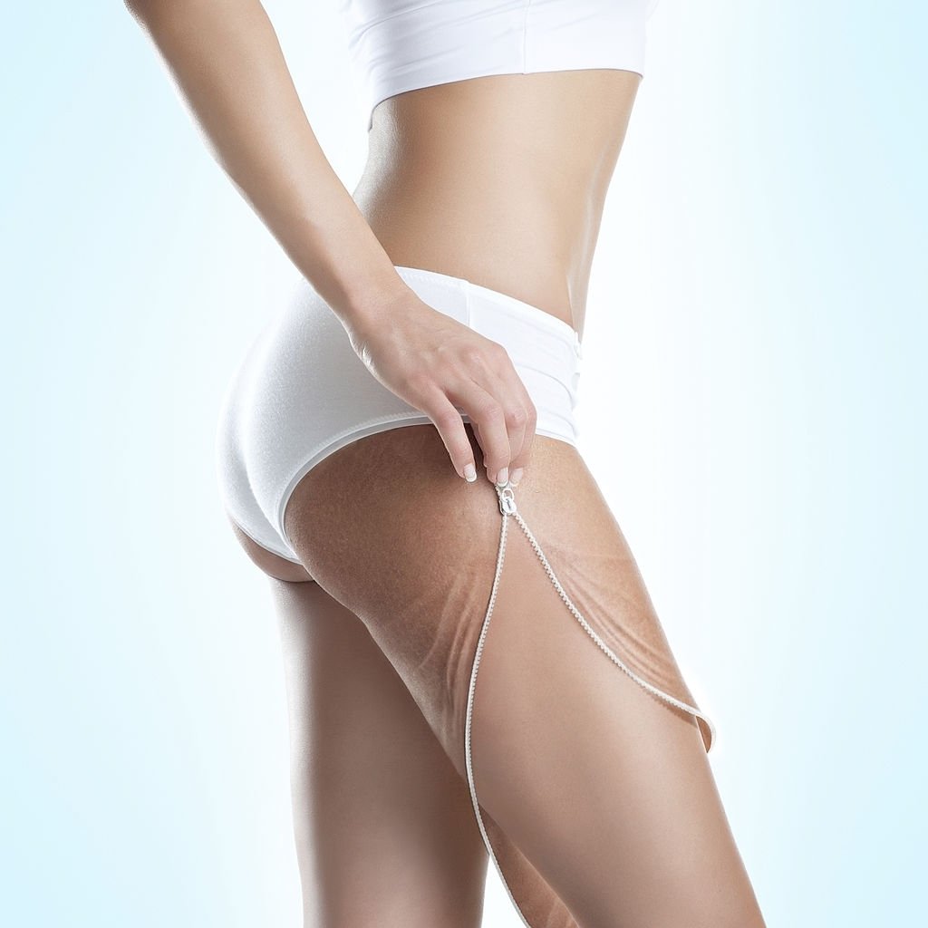 Stretch Marks: How to Get Rid of them