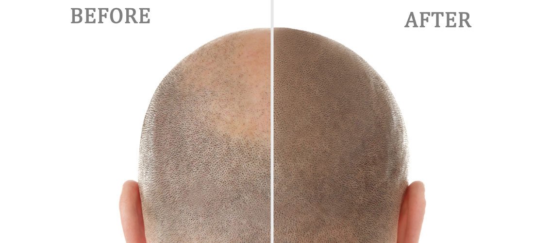 Expect From Scalp Micro-pigmentation